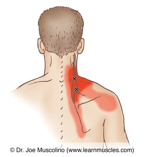 Levator Scapulae - Trigger Points - Learn Muscles