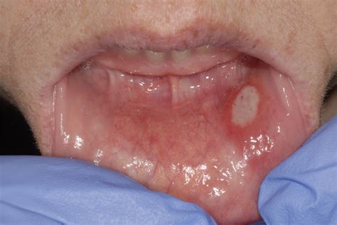 Aphthous Stomatitis In Children