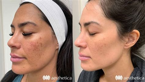 Most Popular Skin Treatment: Chemical Peels | Aesthetica Medical Spa