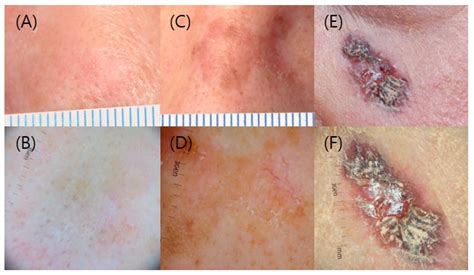 JCM | Free Full-Text | Treatment of Actinic Keratosis: The Best Choice ...