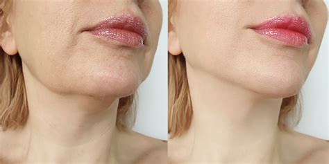 Profhilo London - Before and After - Price - Hannah London Clinic