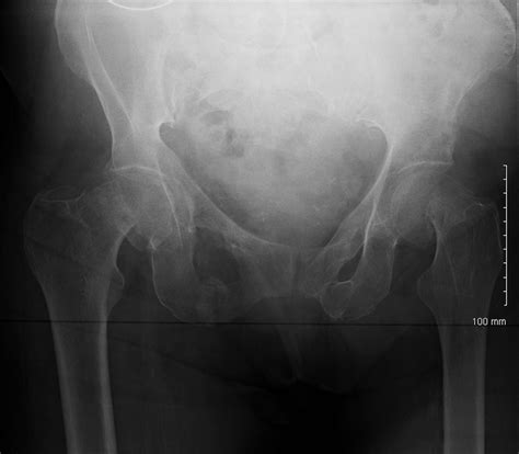 Bilateral neck of femur fractures secondary to seizure | Practical ...