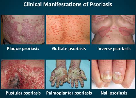 Diagnosis | PSORIASIS THRIVE