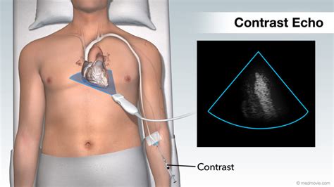 Echocardiogram Heart Ultrasound Vs