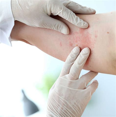 Allergy Doctor Singapore | Dermatologist Dr Wong Soon Tee