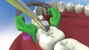 Triodent V3 sectional matrix system - Bite Magazine