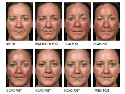 Photodynamic Therapy (PDT) – Dermatology Matters