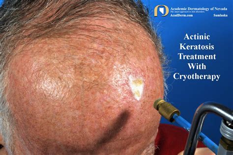 Actinic Keratosis: Treatment-Cryotherapy - Academic Dermatology of Nevada