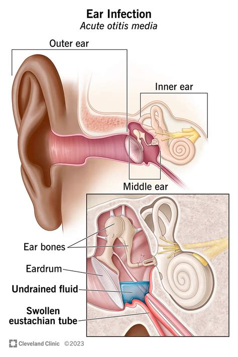 Ear Infection (Otitis Media): Symptoms, Causes & Treatment