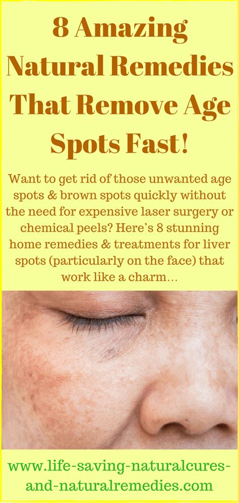 Best Natural Remedies & Home Treatments for Age Spots & Liver Spots ...