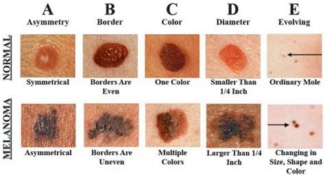 Abcde Rule Of Skin Cancer Detection