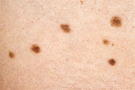 What Skin Cancer Moles Look Like