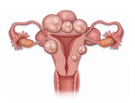 Uterine Fibroids (Myomas): Types, Causes, Symptoms, Diagnosis | SurgMedia