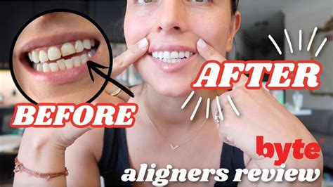 BYTE ALIGNERS REVIEW | progress + byte aligners before & after - YouTube