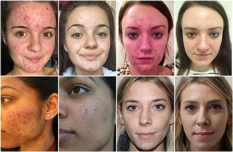 Best Acne treatment UK, Top 5 acne treatments 2018, Acne Skin Clinic London