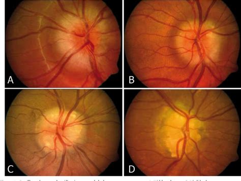 Table 2 from Decreased visual acuity from optic disc drusen | Semantic ...