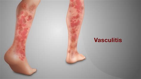 Vasculitis: Symptoms, Causes, and Treatment - Scientific Animations