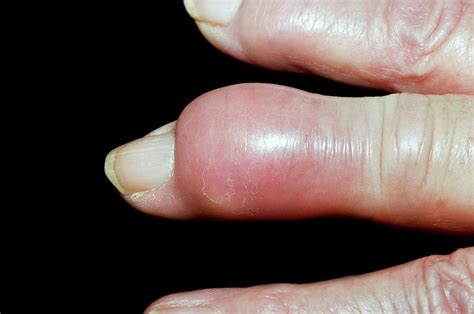 Gout Tophus On The Finger Photograph by Dr P. Marazzi/science Photo Library