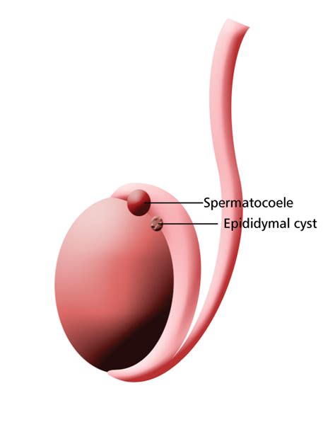 Epididymal Cyst