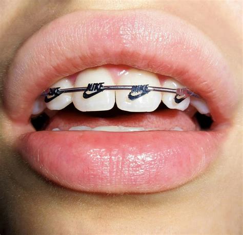 Pin by CUTEASFK on Imagine | Cute braces colors, Cute braces, Braces colors