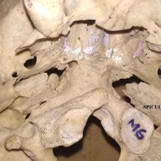 Photograph of base of skull showing Confluent foramen ovale and foramen ...