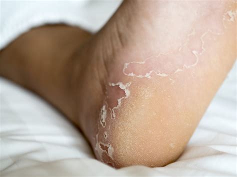 What Causes Itchy Feet? 4 Common Causes - JAWS podiatry