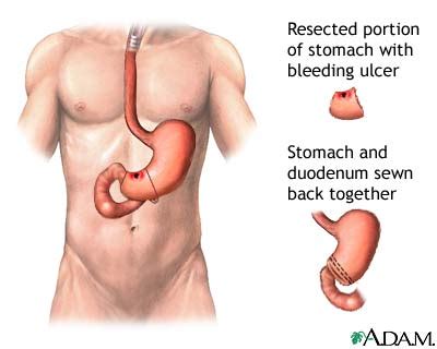 Gastrointestinal Bleeding - Wake Gastroenterology