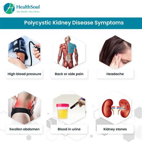 Polycystic Kidney Disease: Symptoms, Diagnosis, and Treatment – Healthsoul