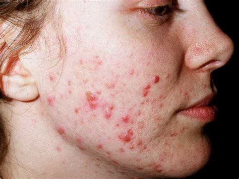 [Figure, Acne Vulgaris DermNet New Zealand] - StatPearls - NCBI Bookshelf