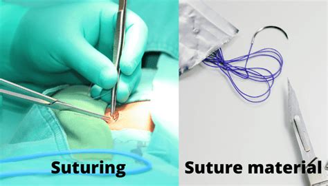 Suture - Suture Basics