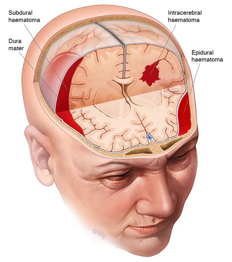 Traumatic Brain Injury