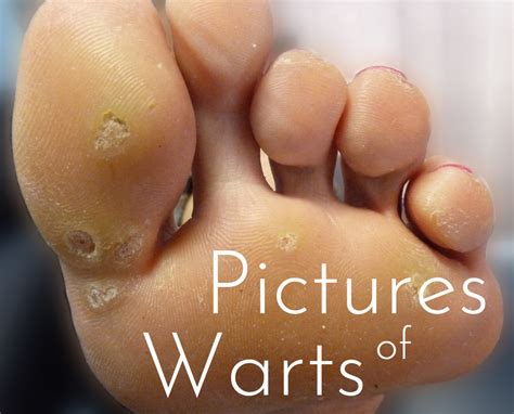 My Experience With Warts: Causes, Home Treatments, and Pictures ...