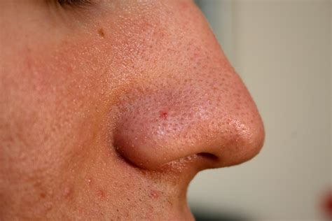 Medical Pictures Info – Blackhead