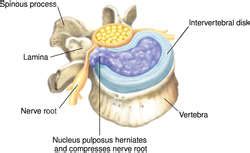 Herniation of nucleus pulposus | definition of herniation of nucleus ...