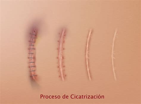 Postoperatorio - Como cuidar tus cicatrices | Dr. Díaz Infante - Madrid