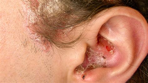 Plaque Psoriasis Ear