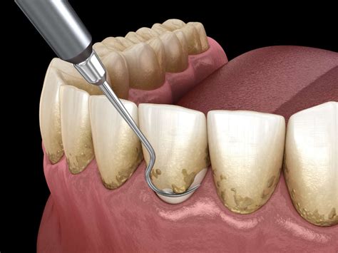 How to Remove Dental Plaque at Home - TheDentech.com