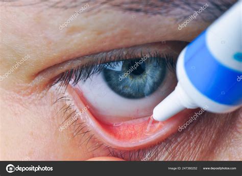 Implementation Drug Conjunctival Sac Instill Eye Ointment — Stock Photo ...