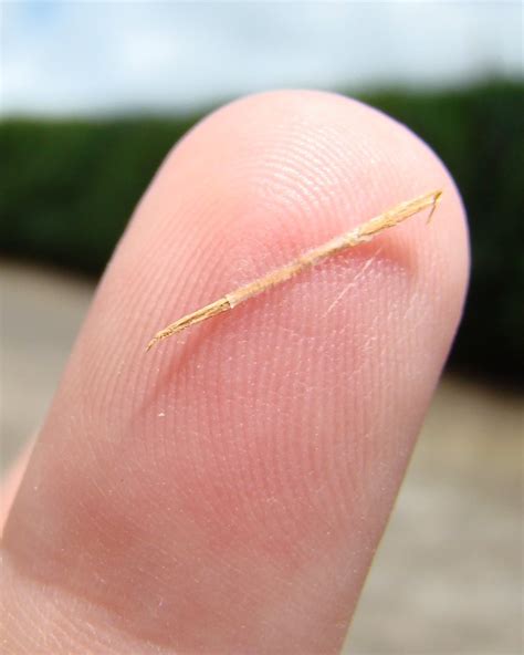 Infected sliver in finger. Splinter Removal: Expert Guide to Safe and ...