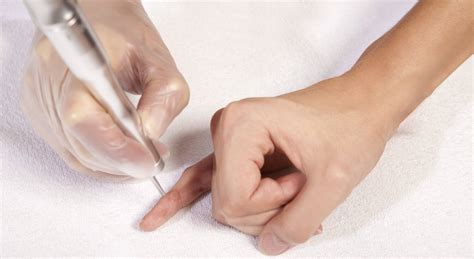 Cryosurgery wart removal from £69 in North London — MOYAL THERAPIES