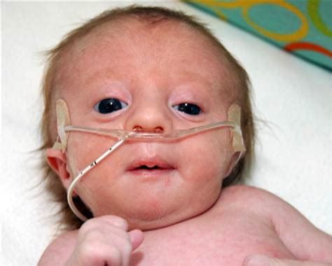 Edwards Syndrome - Symptoms, Treatment, Pictures, Life Expectancy | Health9