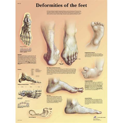 Foot Deformities