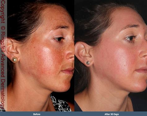 Melasma Before After