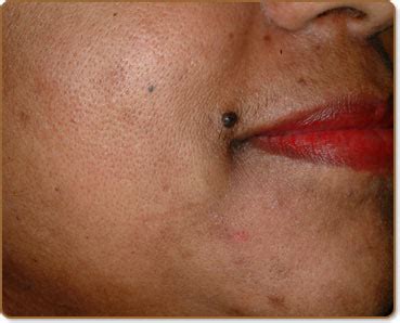 ACNE / POST-INFLAMMATORY HYPERPIGMENTATION -> Before/After Photos ...