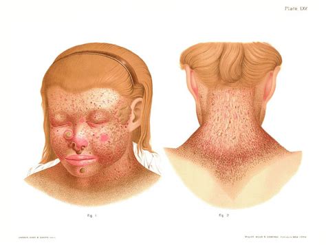 Xeroderma Pigmentosum Photograph by Us National Library Of Medicine ...