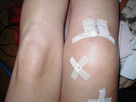 Knee Surgery to Repair the Meniscus Show High Failure Rate