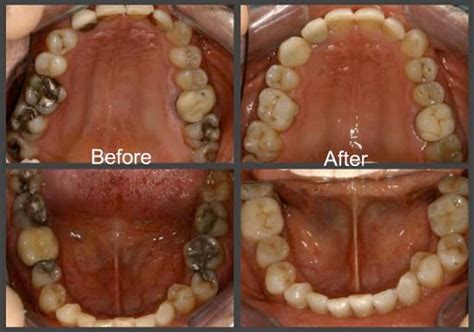 Dental Inlays And Onlays at Dentists Esthetix Dental Spa, NY