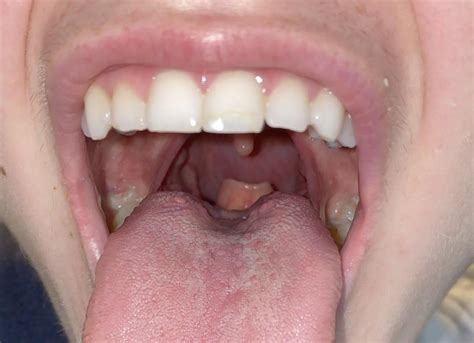 Visible Epiglottis : r/medical_advice