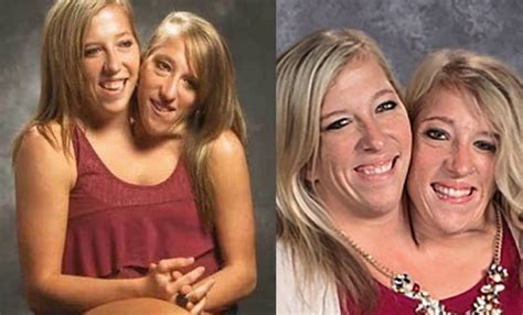 Everything To Know About Famous Conjoined Twins Abby And Brittany ...