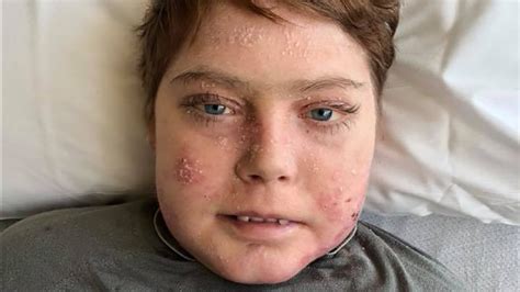 Teen dubbed 'butterfly boy' dies of rare skin disease; Ottawa Senators ...